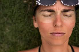 How to Heal & Treat Peeling Skin | Tips for Sunburn Recovery